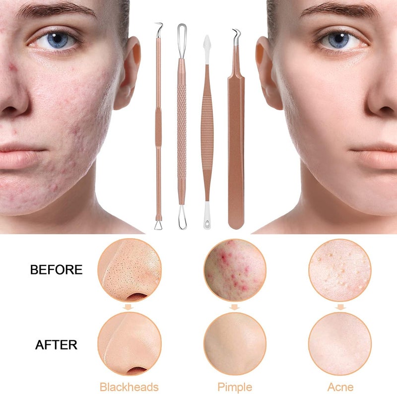 MENOLY Pimple Popper Tool Kit, 10 Pcs Blackhead Remover Comedone Extractor Acne Removal Kit for Blemish, Whitehead Popping,Zit Removing for Nose Face Tools with a Leather Bag (Rose Gold) - Image 5